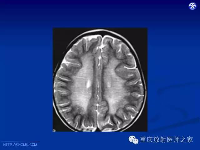【PPT】脑白质髓鞘化及相关疾病的MRI表现-37