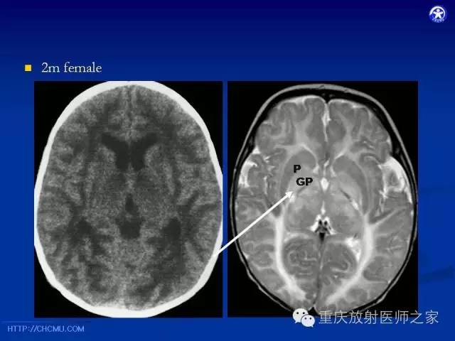 【PPT】脑白质髓鞘化及相关疾病的MRI表现-25