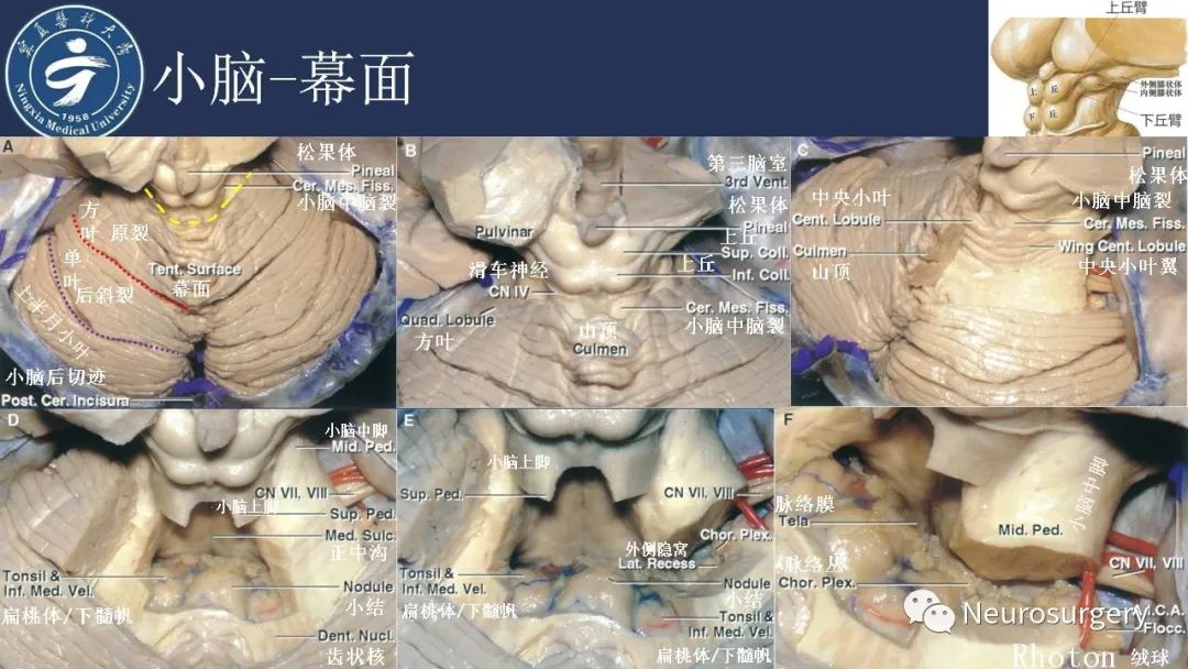 【PPT】小脑解剖-14