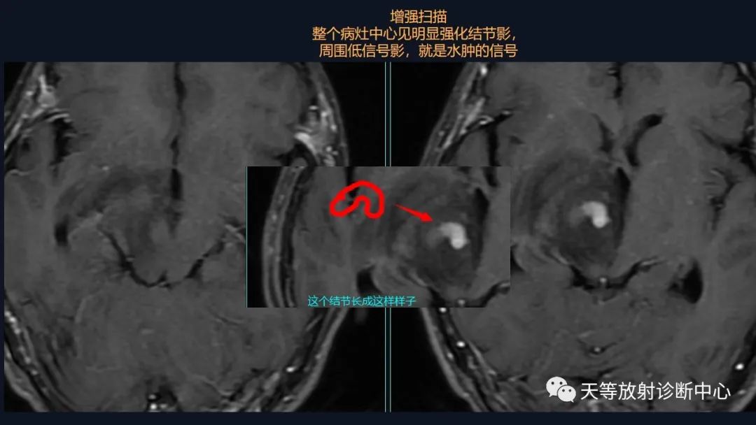 【病例】脑内淋巴瘤1例MR影像分析-26