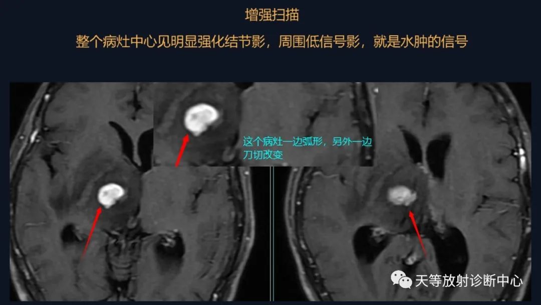 【病例】脑内淋巴瘤1例MR影像分析-25