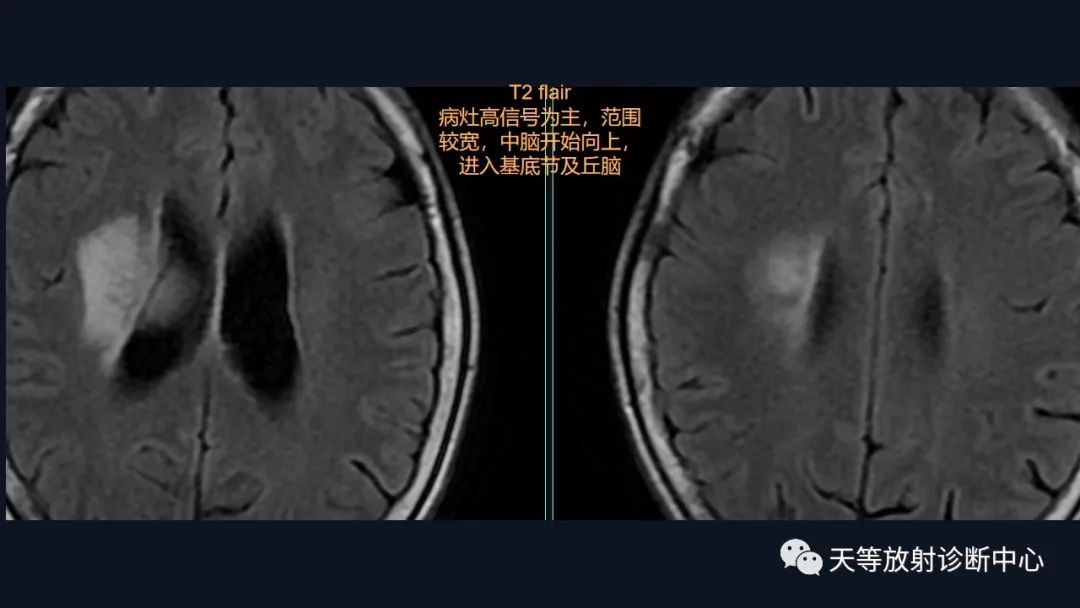 【病例】脑内淋巴瘤1例MR影像分析-20