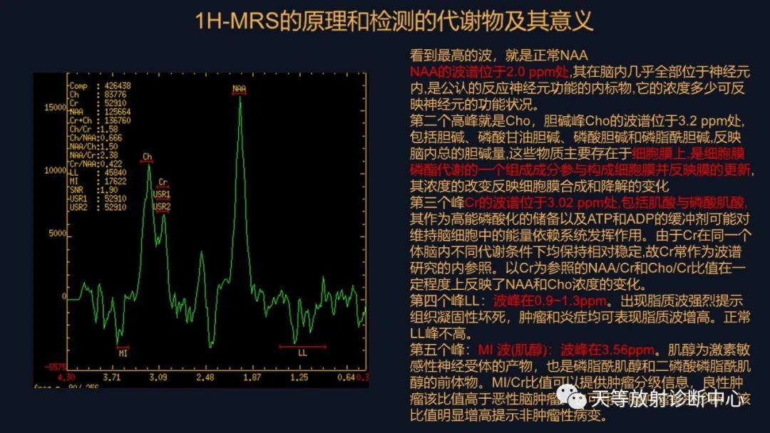 【病例】脑内淋巴瘤1例MR影像分析-33
