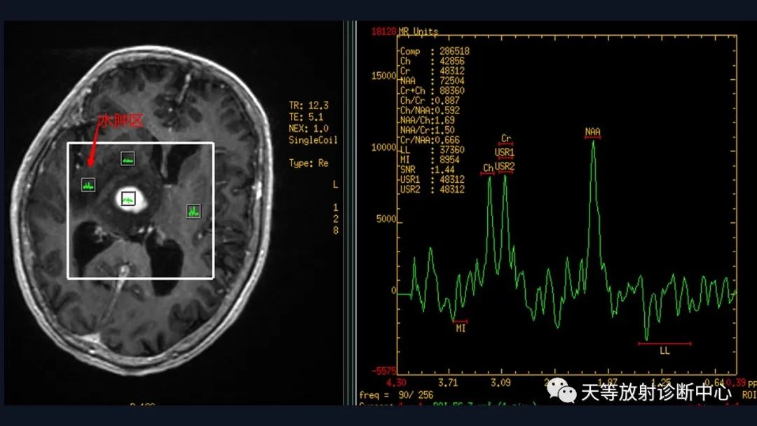 【病例】脑内淋巴瘤1例MR影像分析-44
