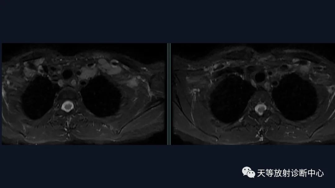 【病例】脑内淋巴瘤1例MR影像分析-7