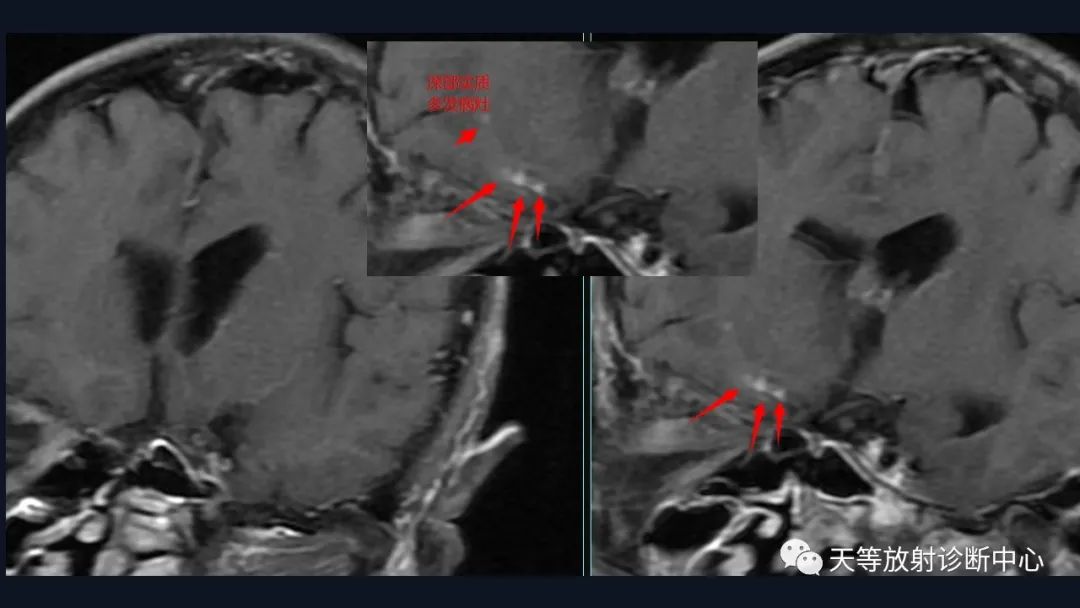 【病例】脑内淋巴瘤1例MR影像分析-30