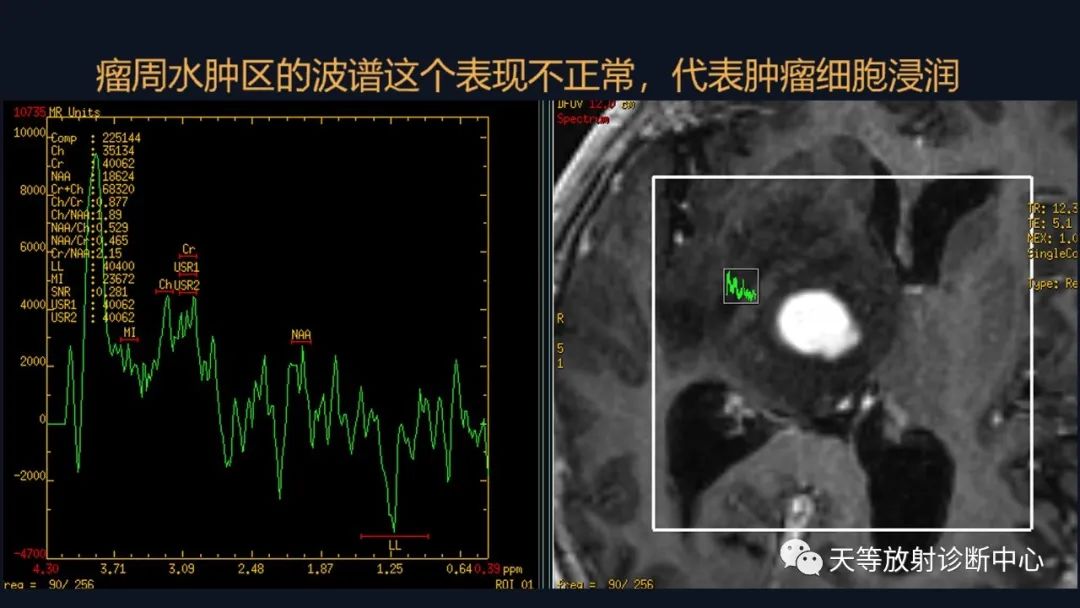 【病例】脑内淋巴瘤1例MR影像分析-38