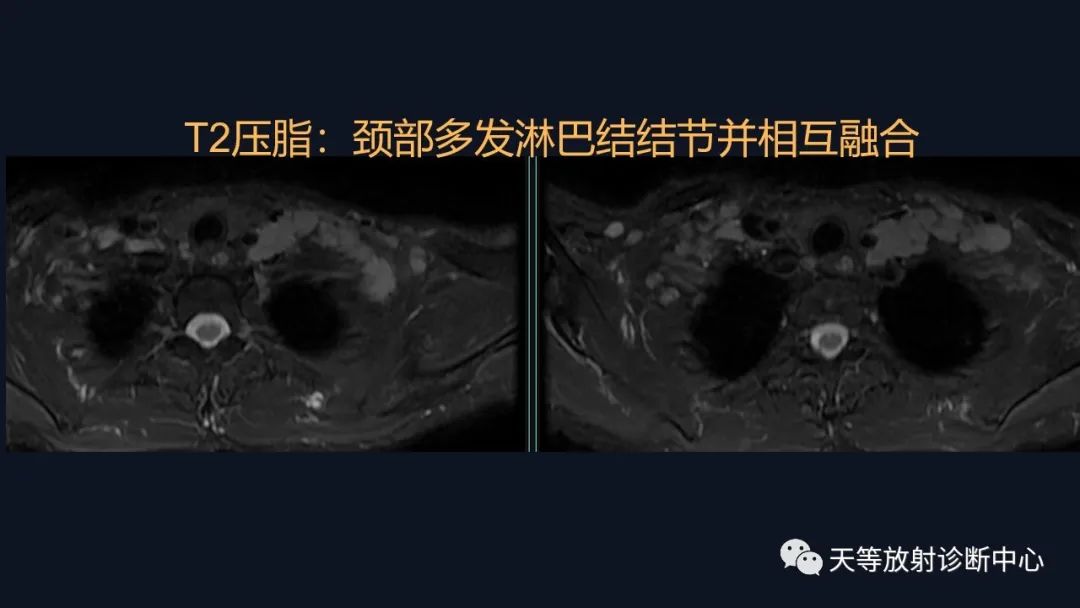 【病例】脑内淋巴瘤1例MR影像分析-8