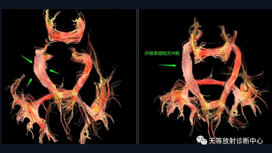 【病例】脑内淋巴瘤1例MR影像分析-50