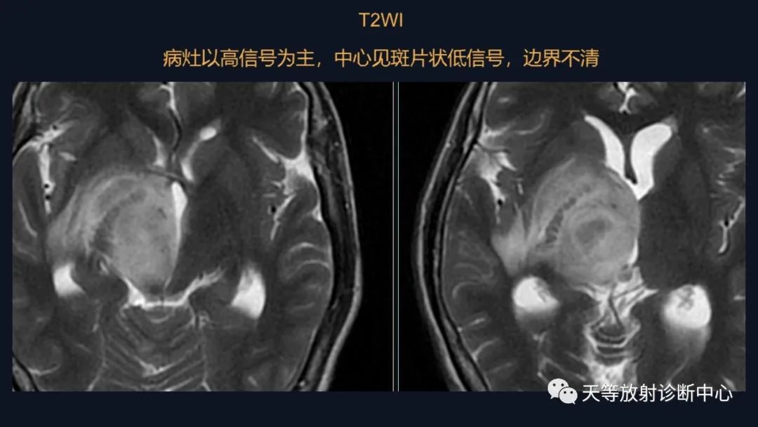 【病例】脑内淋巴瘤1例MR影像分析-21
