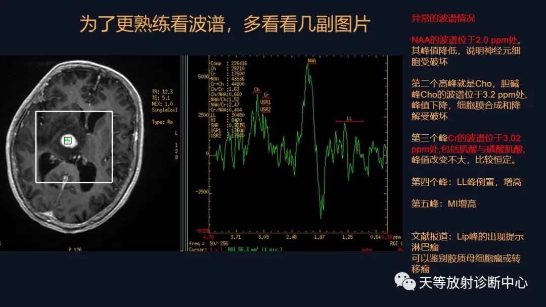 【病例】脑内淋巴瘤1例MR影像分析-41