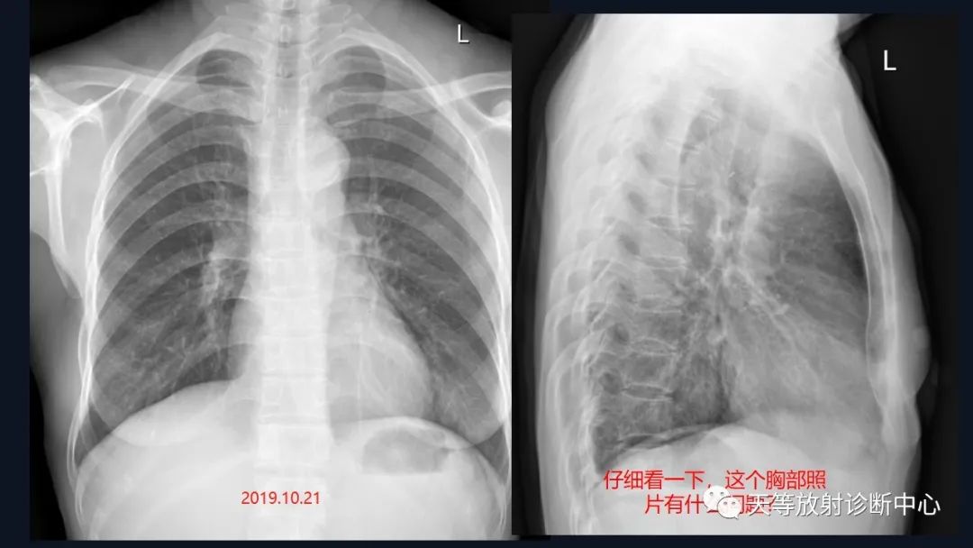 【病例】脑内淋巴瘤1例MR影像分析-2