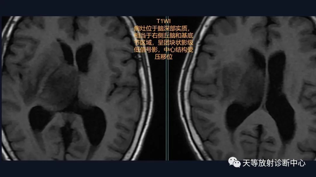 【病例】脑内淋巴瘤1例MR影像分析-16