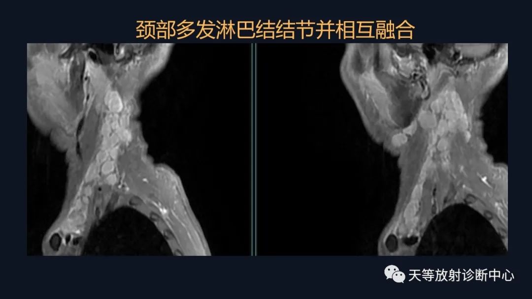 【病例】脑内淋巴瘤1例MR影像分析-11