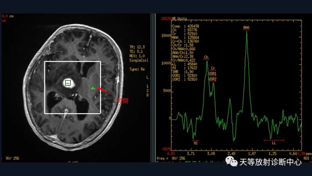 【病例】脑内淋巴瘤1例MR影像分析-42