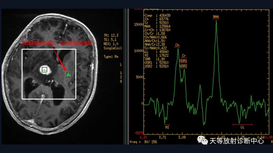 【病例】脑内淋巴瘤1例MR影像分析-47