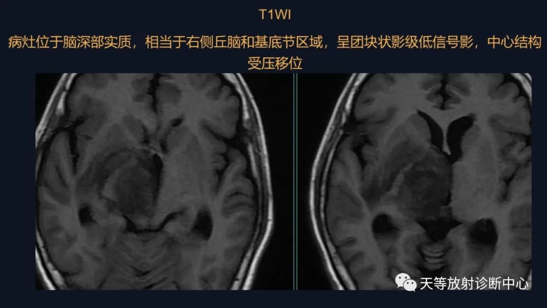 【病例】脑内淋巴瘤1例MR影像分析-15