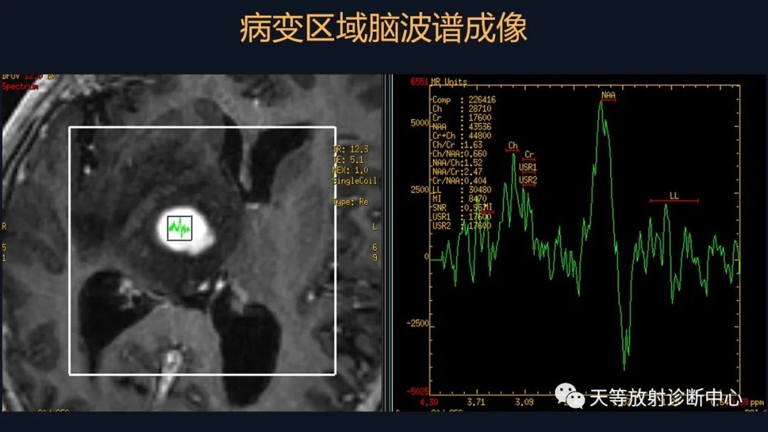 【病例】脑内淋巴瘤1例MR影像分析-35