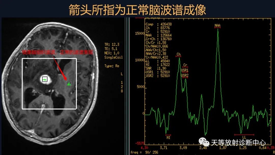 【病例】脑内淋巴瘤1例MR影像分析-32