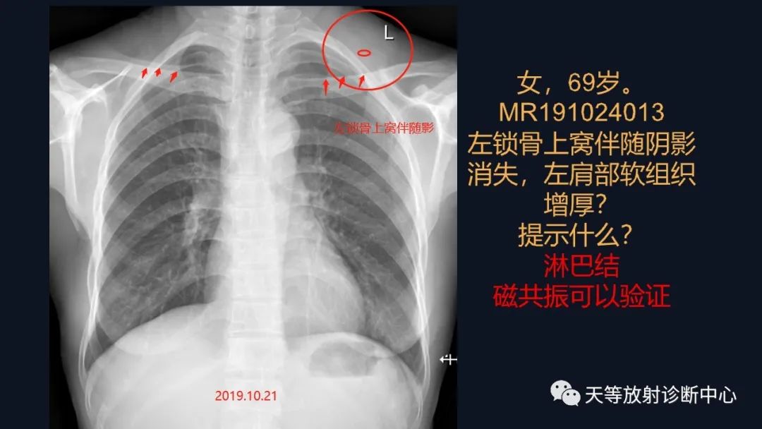 【病例】脑内淋巴瘤1例MR影像分析-3