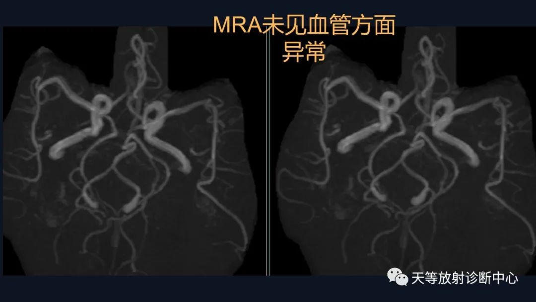 【病例】脑内淋巴瘤1例MR影像分析-31
