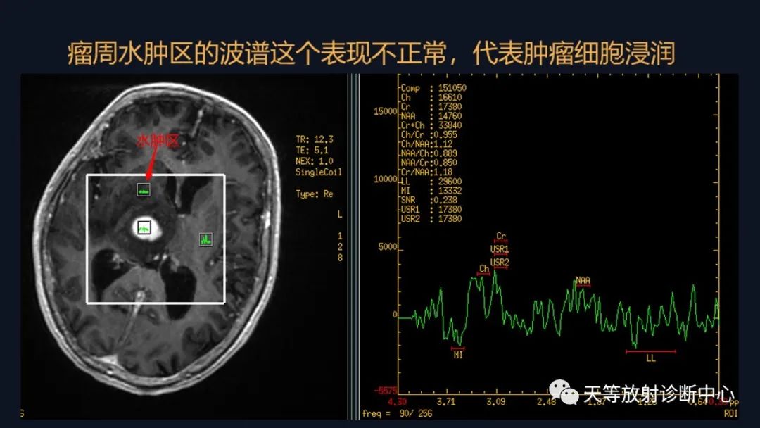 【病例】脑内淋巴瘤1例MR影像分析-43