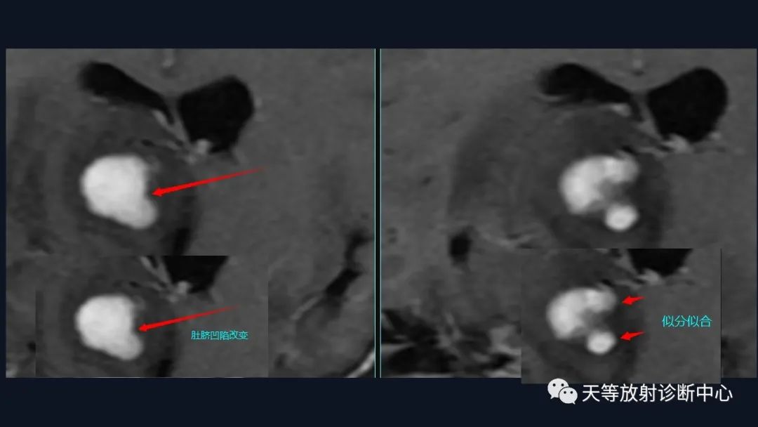 【病例】脑内淋巴瘤1例MR影像分析-27