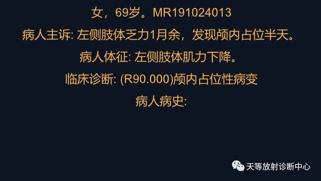 脑内淋巴瘤1例MR影像分析
