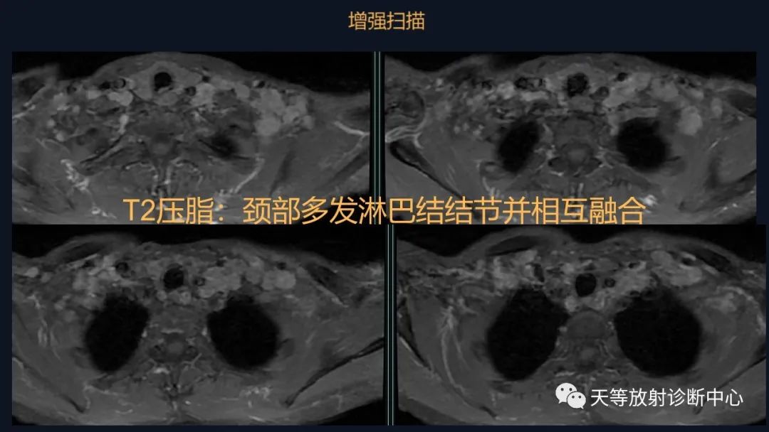 【病例】脑内淋巴瘤1例MR影像分析-10