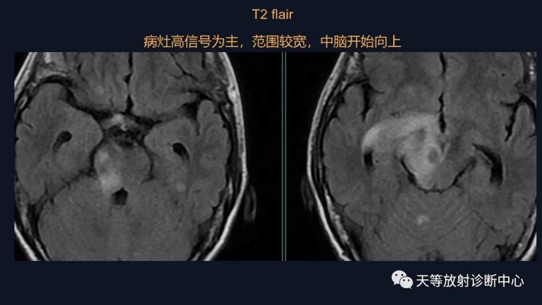 【病例】脑内淋巴瘤1例MR影像分析-17