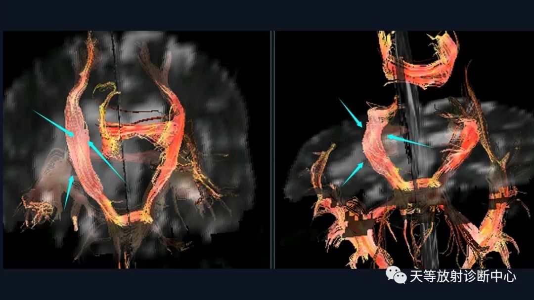 【病例】脑内淋巴瘤1例MR影像分析-49