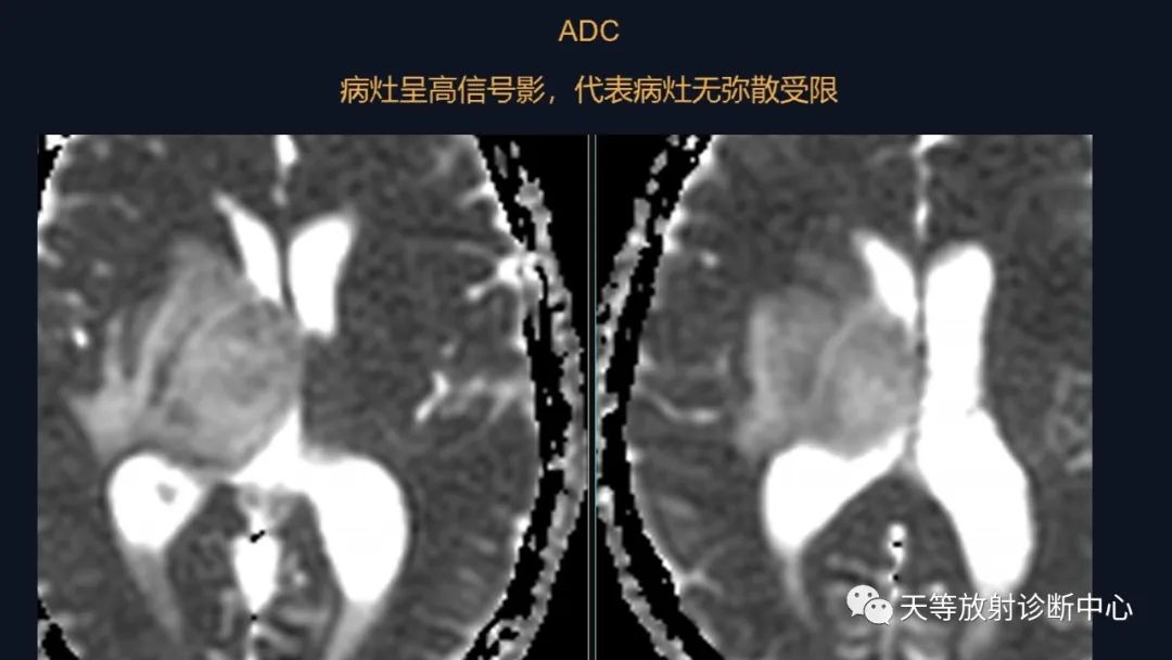 【病例】脑内淋巴瘤1例MR影像分析-24