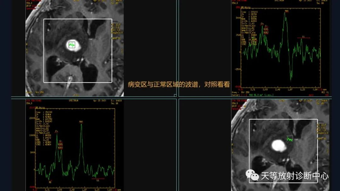 【病例】脑内淋巴瘤1例MR影像分析-40