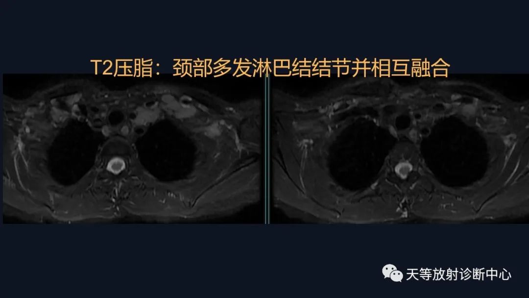 【病例】脑内淋巴瘤1例MR影像分析-9