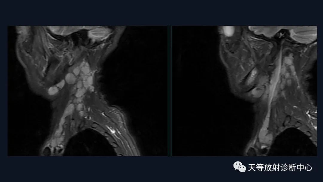 【病例】脑内淋巴瘤1例MR影像分析-6