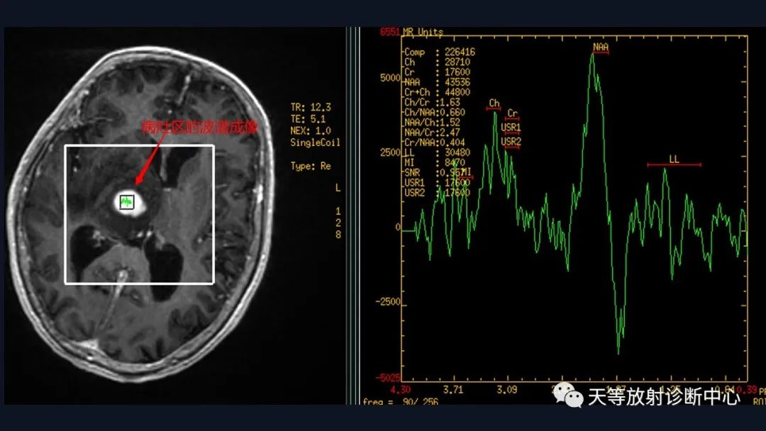 【病例】脑内淋巴瘤1例MR影像分析-45