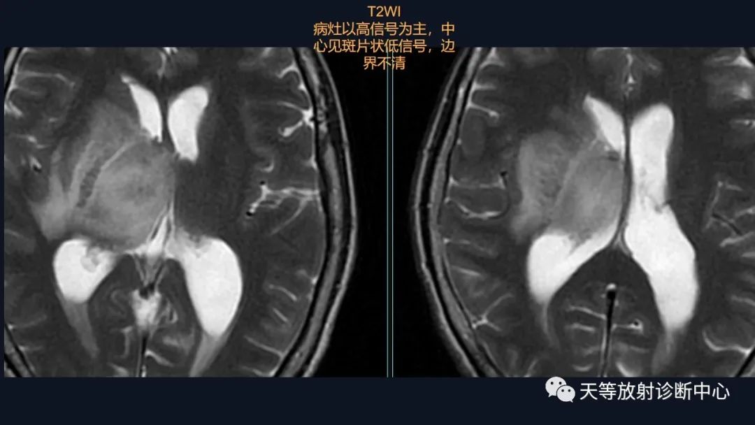 【病例】脑内淋巴瘤1例MR影像分析-22