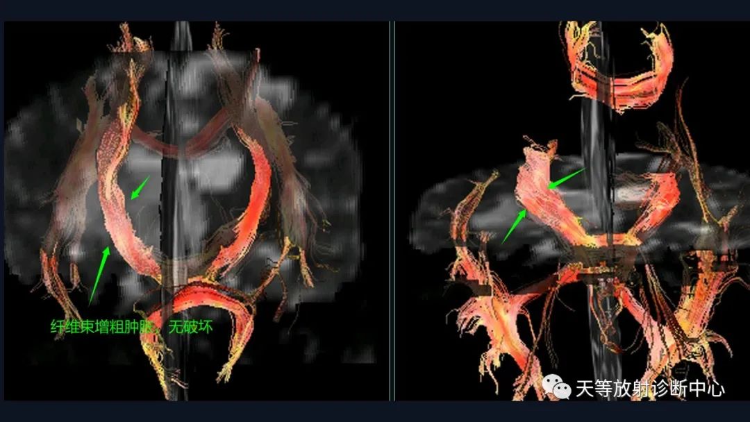 【病例】脑内淋巴瘤1例MR影像分析-48