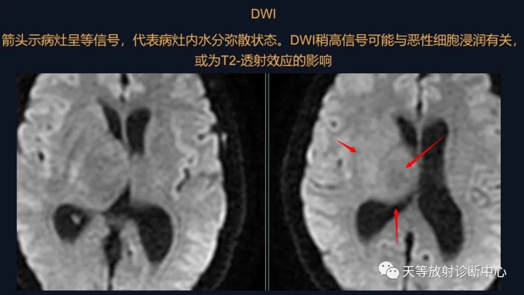 【病例】脑内淋巴瘤1例MR影像分析-23