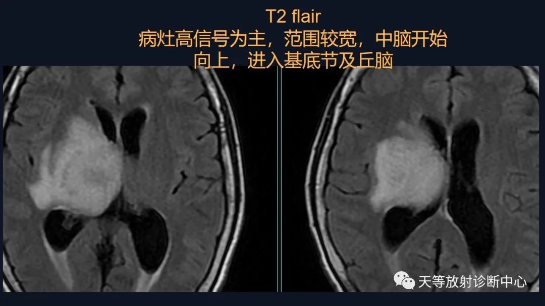 【病例】脑内淋巴瘤1例MR影像分析-19
