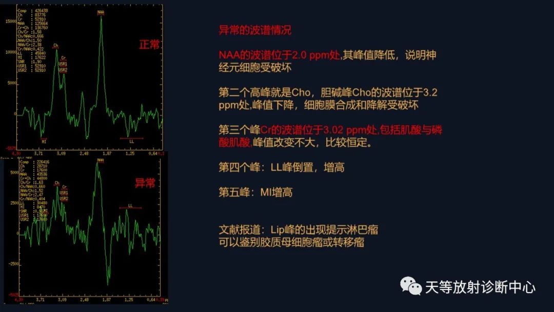 【病例】脑内淋巴瘤1例MR影像分析-36