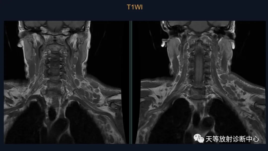 【病例】脑内淋巴瘤1例MR影像分析-13