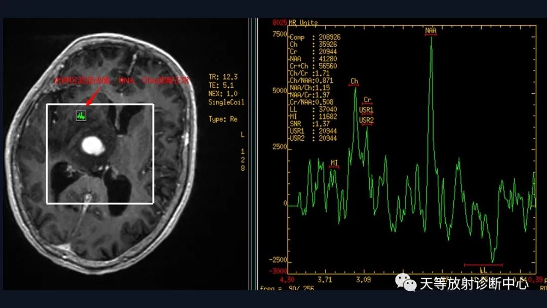 【病例】脑内淋巴瘤1例MR影像分析-46