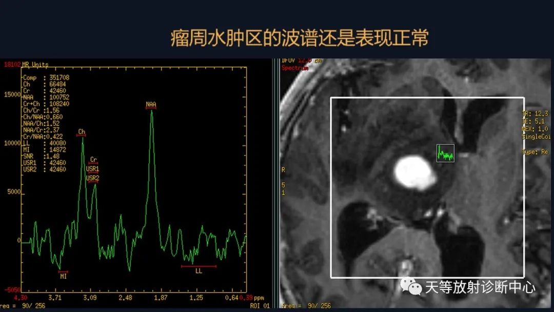 【病例】脑内淋巴瘤1例MR影像分析-37