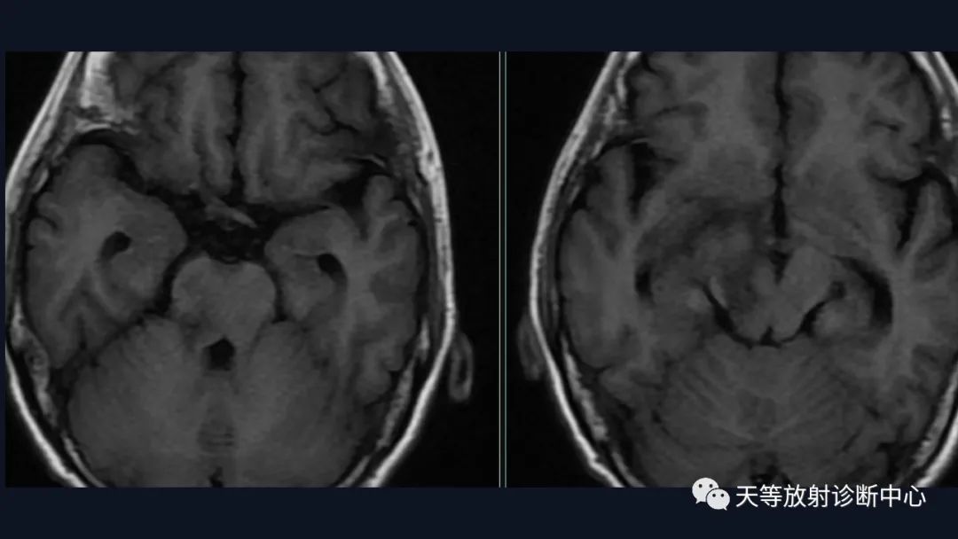 【病例】脑内淋巴瘤1例MR影像分析-14