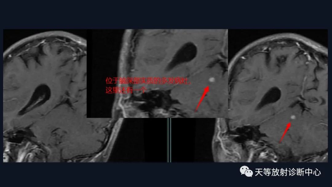 【病例】脑内淋巴瘤1例MR影像分析-29