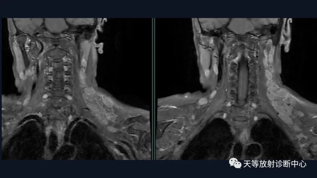 【病例】脑内淋巴瘤1例MR影像分析-12