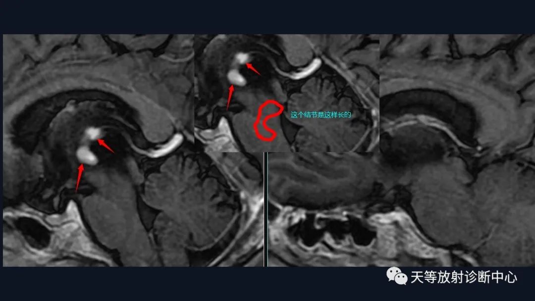 【病例】脑内淋巴瘤1例MR影像分析-28