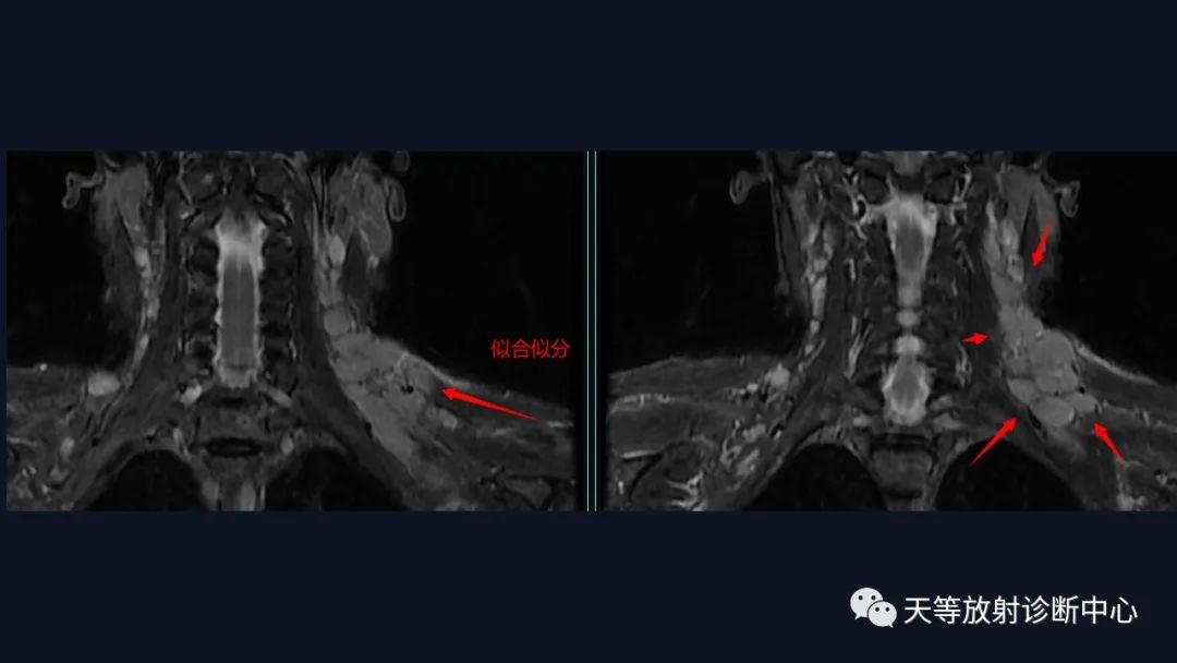 【病例】脑内淋巴瘤1例MR影像分析-5