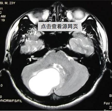 18种脑囊肿或囊肿样占位的影像对比-29